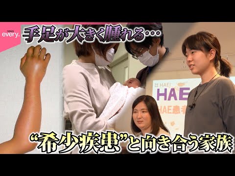 【難病】“知ってほしい希少疾患”患者が少なく診断遅れも…診断が遅れ夫を亡くした家族や病と前向きに向き合う女性の挑戦『every.特集』