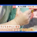 大人も注意「手足口病」急増！のどにプツプツ「痛くて食べられない飲めない」 子育て現場では手洗い徹底＆個別タオル　大人も子どもも引き続き注意が必要｜TBS NEWS DIG