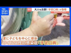 大人も注意「手足口病」急増！のどにプツプツ「痛くて食べられない飲めない」 子育て現場では手洗い徹底＆個別タオル　大人も子どもも引き続き注意が必要｜TBS NEWS DIG