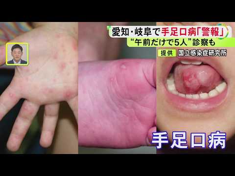 ワクチンや治療薬なく…子供を中心に流行中の『手足口病』症状が収まった後もウイルスの排泄続き大人も注意